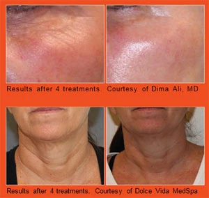 Before and after using Venus Viva for 4 treatments